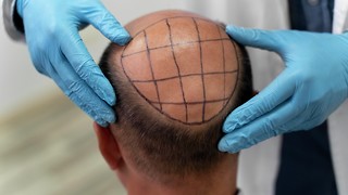 Turkey’s Rise to the Top: The Story Behind the Hair Transplant Capital