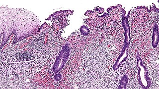 Endometriosis treatment: same old status quo?