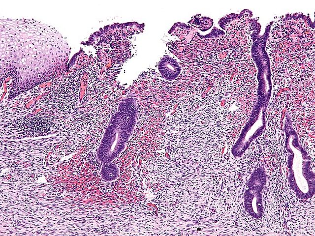 Endometriosis treatment: same old status quo?